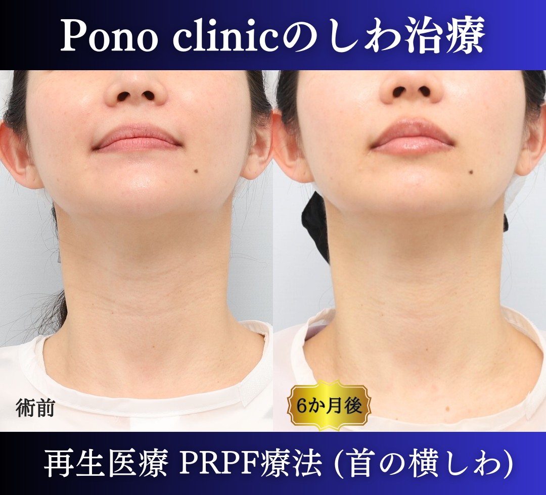 PRPF療法首の横シワ改善の症例、上