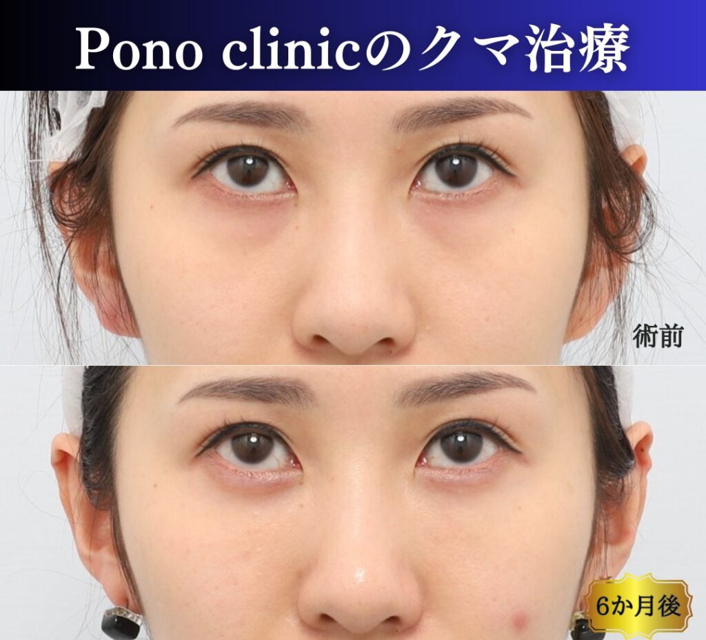 クマ治療の裏ミッドフェイスリフト、PRPF療法の症例、アップ