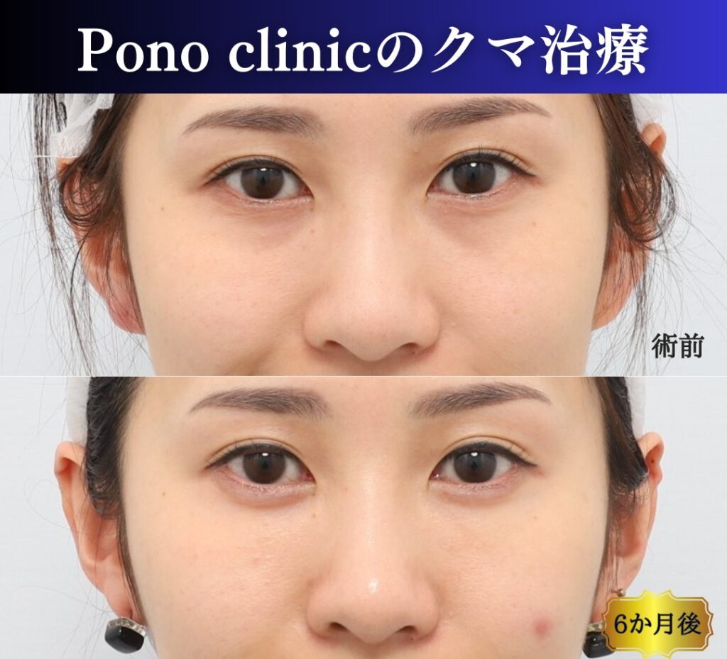 クマ治療の裏ミッドフェイスリフト、PRPF療法の症例、笑顔