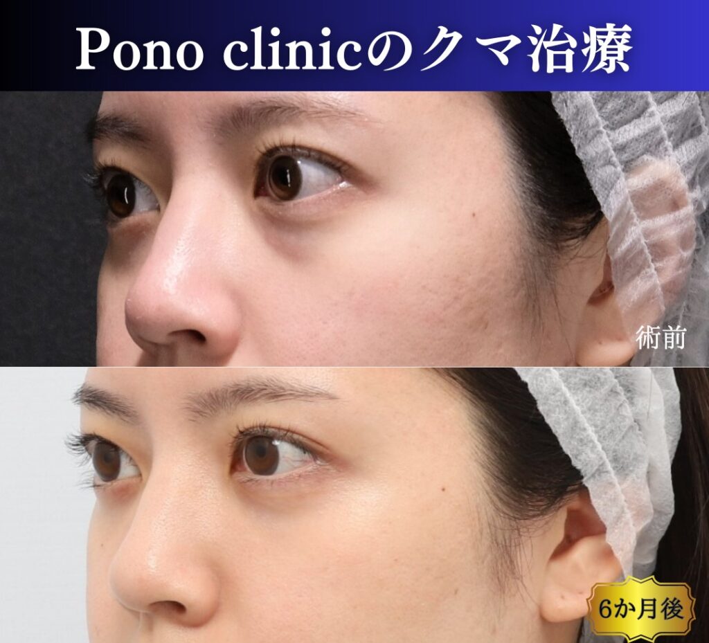 クマ治療の裏ミッドフェイスリフト、斜め