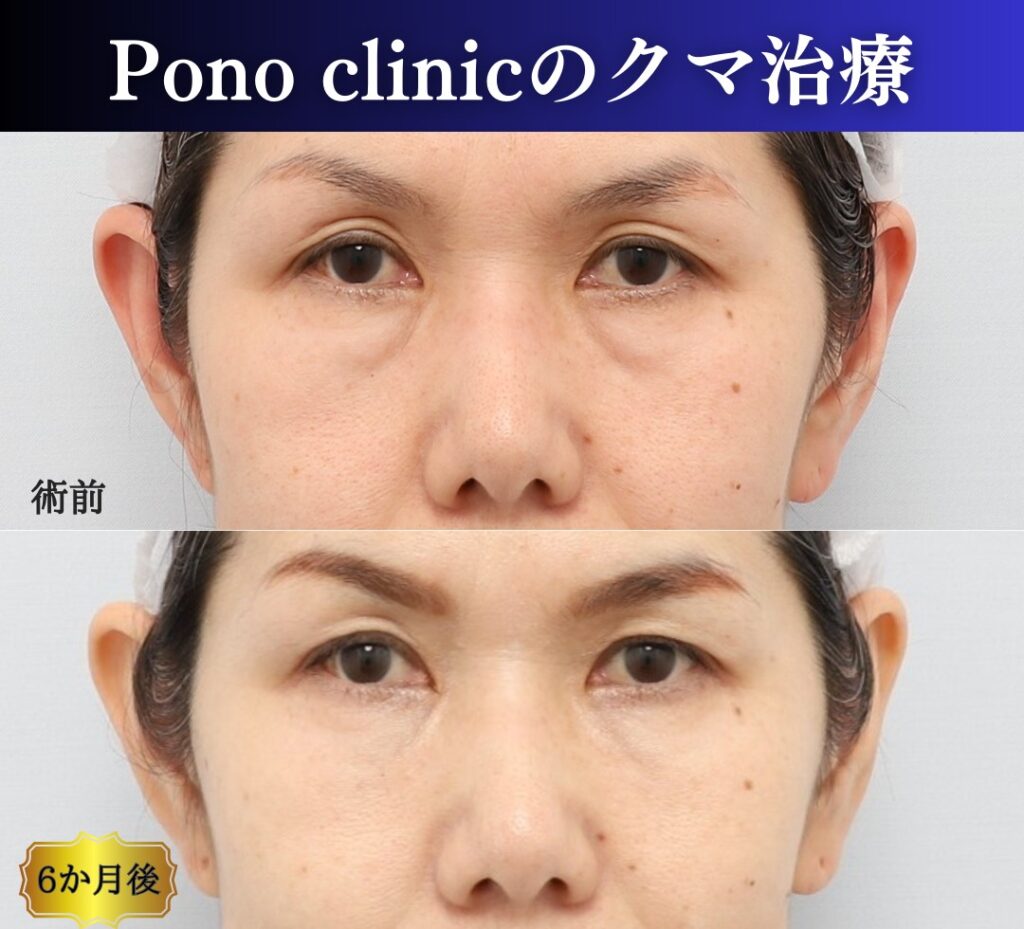 クマ治療の裏ミッドフェイスリフトの症例、アップ