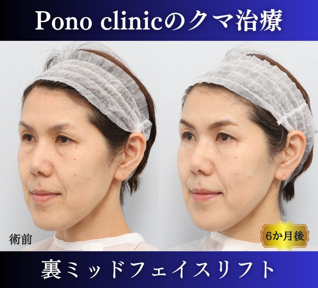 クマ治療の裏ミッドフェイスリフトの症例、横顔