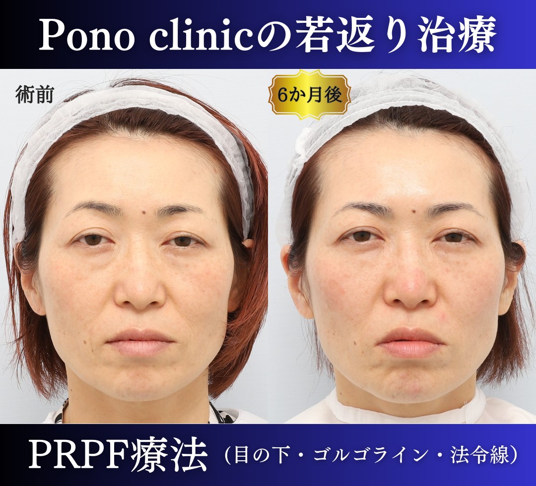 若返り治療のPRPF療法、正面