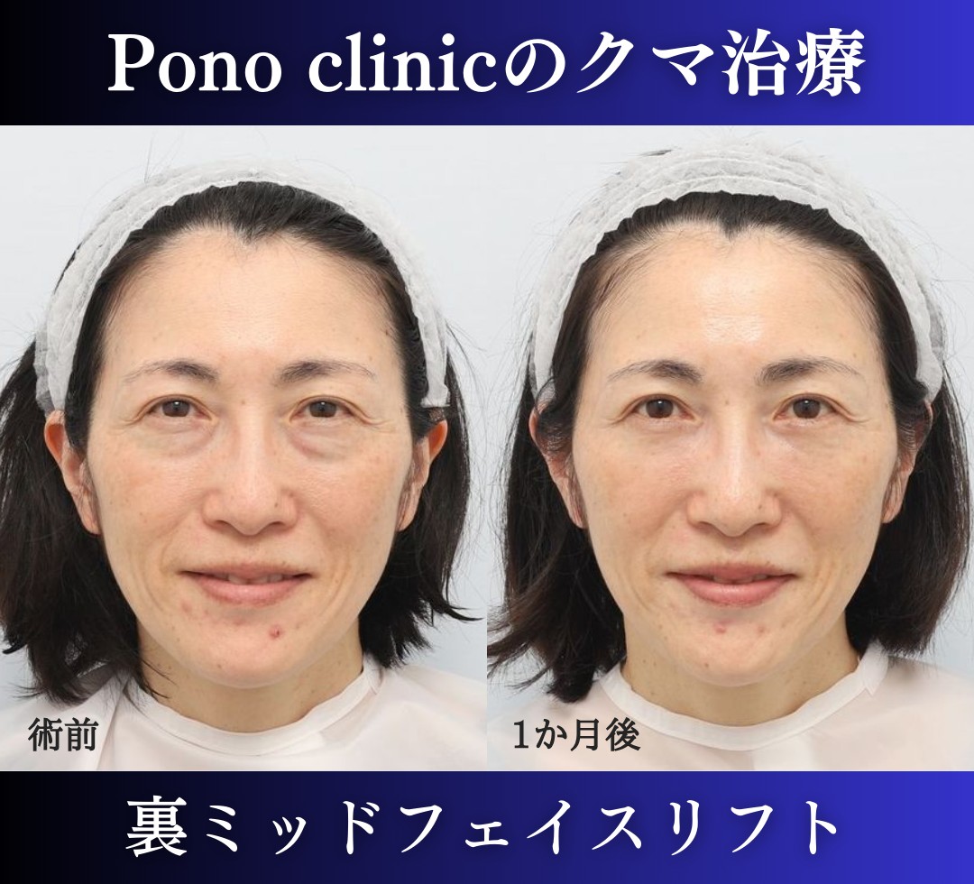 裏ハムラ、ミッドフェイスリフトの症例、術後1か月笑顔