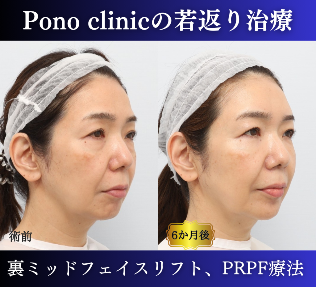 裏ミッドフェイスリフト、PRPF療法 (2)