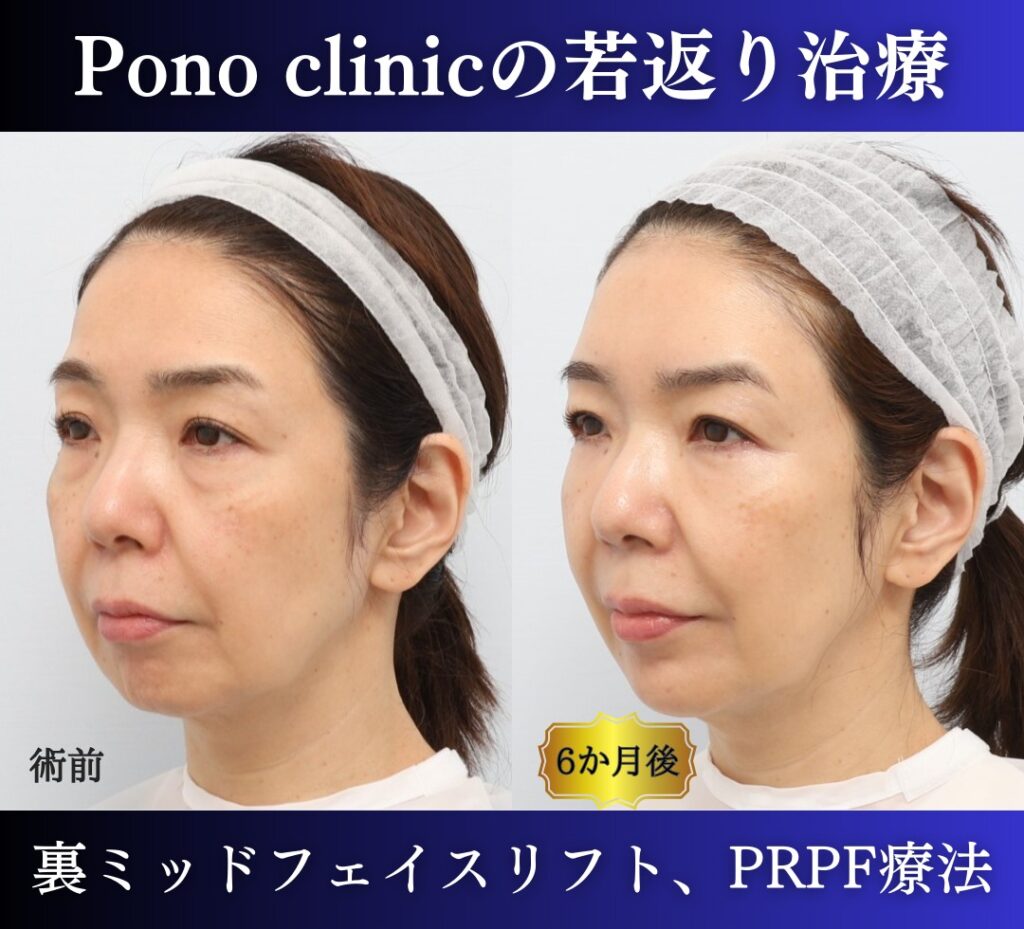 裏ミッドフェイスリフト、PRP（目の下、法令線、額、コメカミ）6か月後の症例