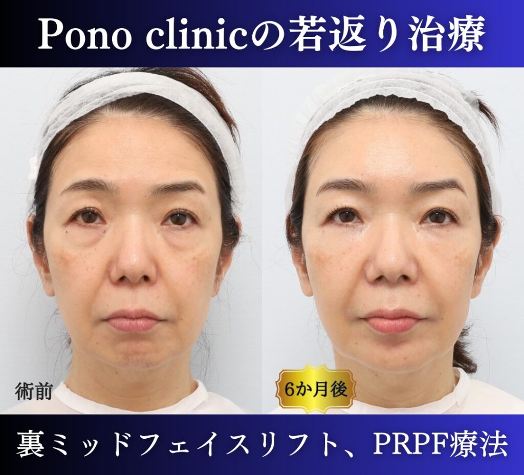 裏ミッドフェイスリフト、PRP（目の下、法令線、額、コメカミ）6か月後の症例正面