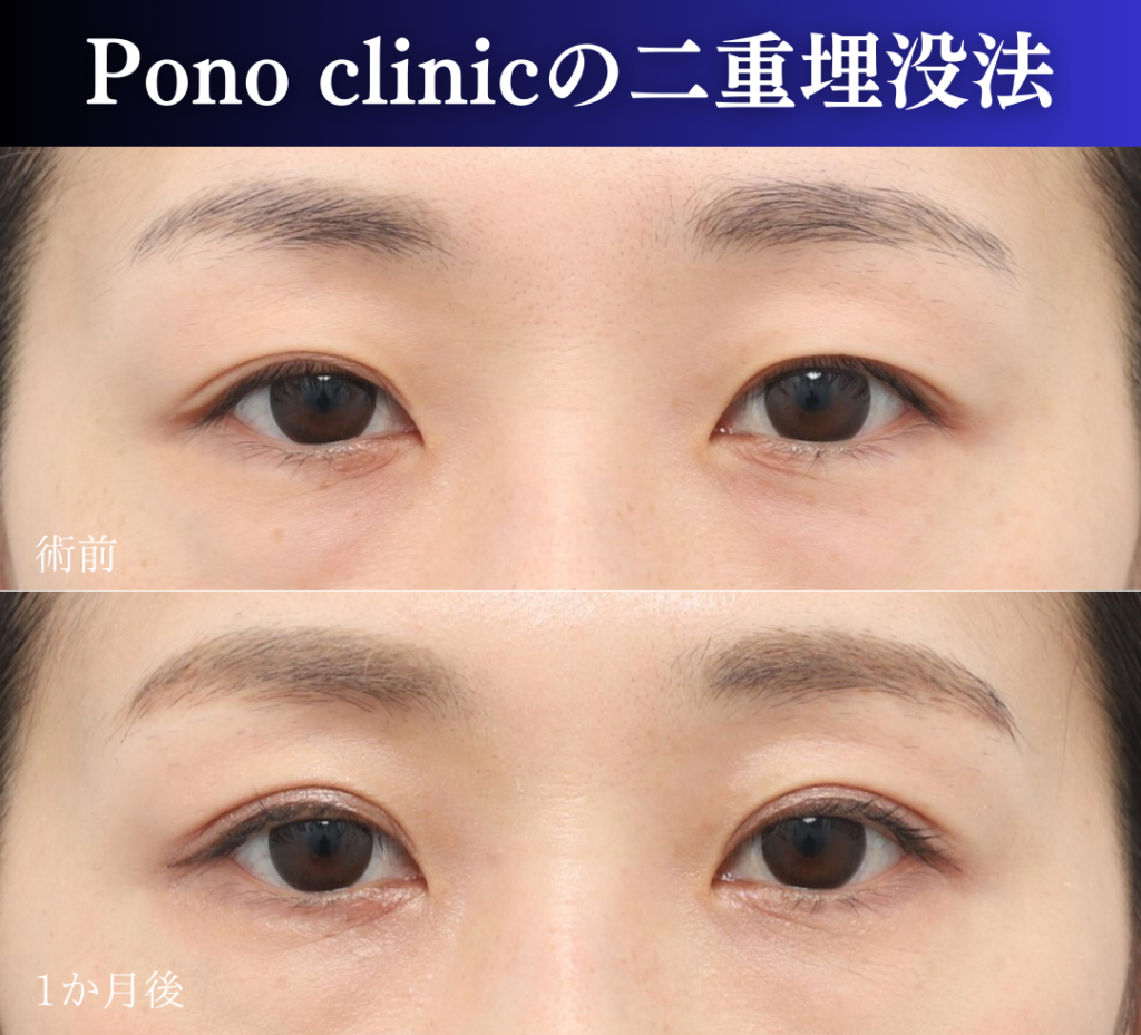 二重埋没2ループ症例