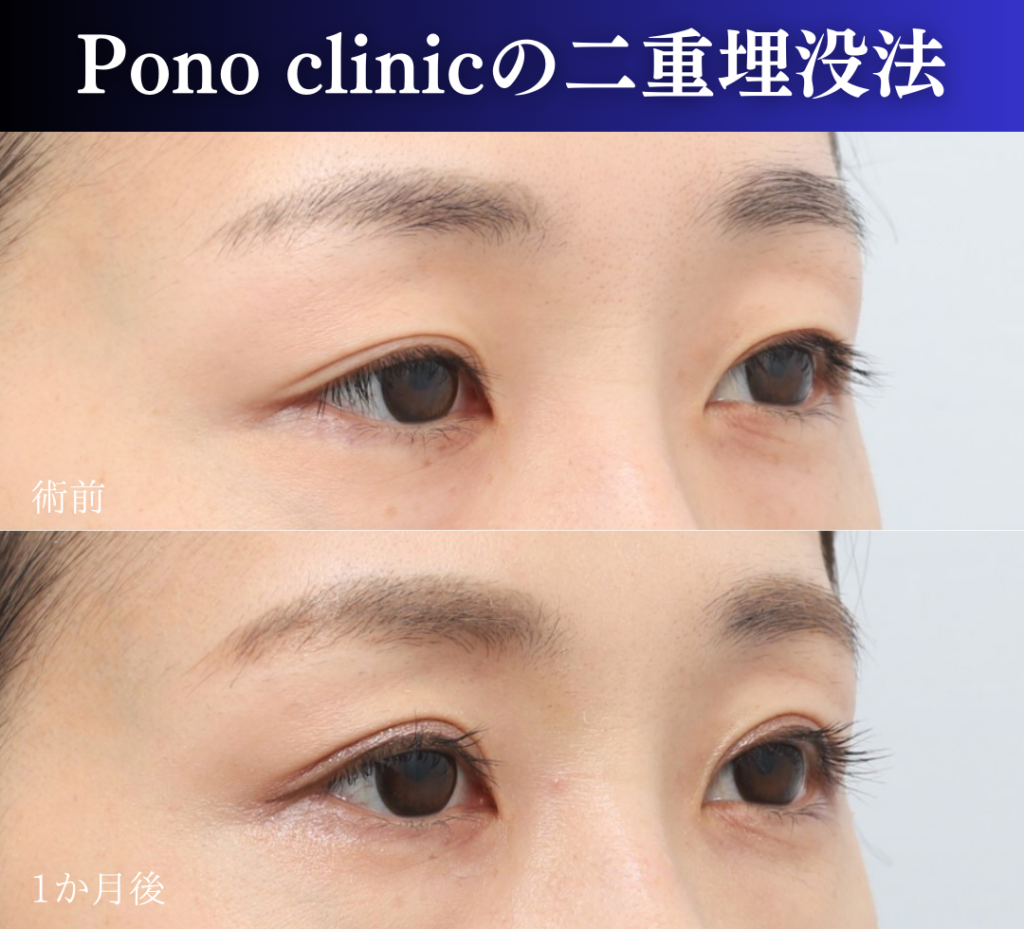 二重埋没2ループ症例 (2)