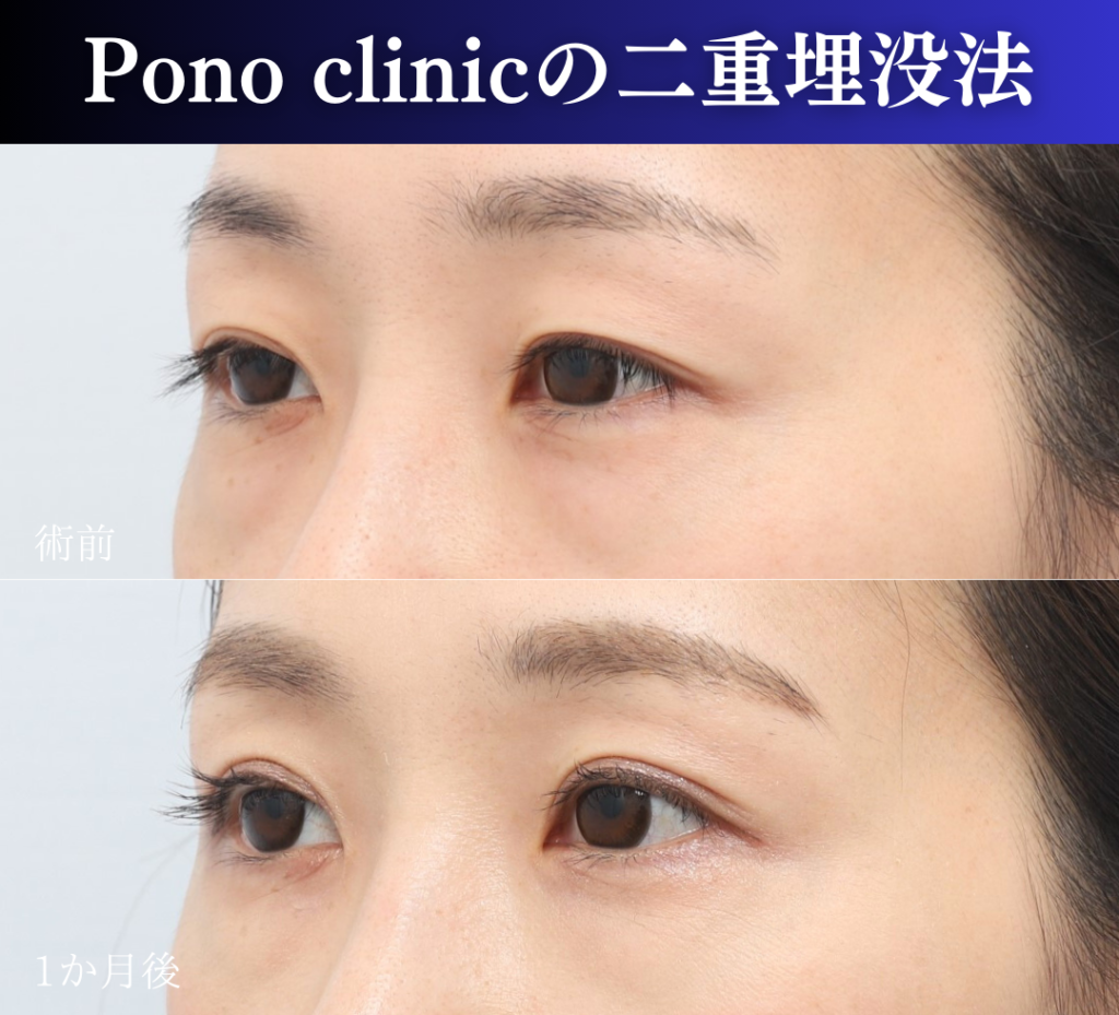 二重埋没2ループ症例 (3)