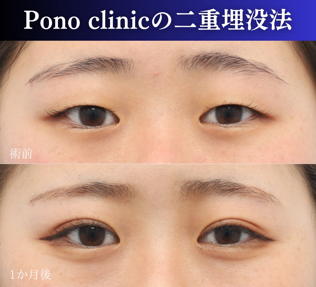 二重埋没法2ループの症例、正面