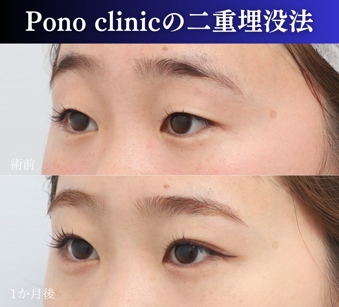 二重埋没法2ループの症例。斜め