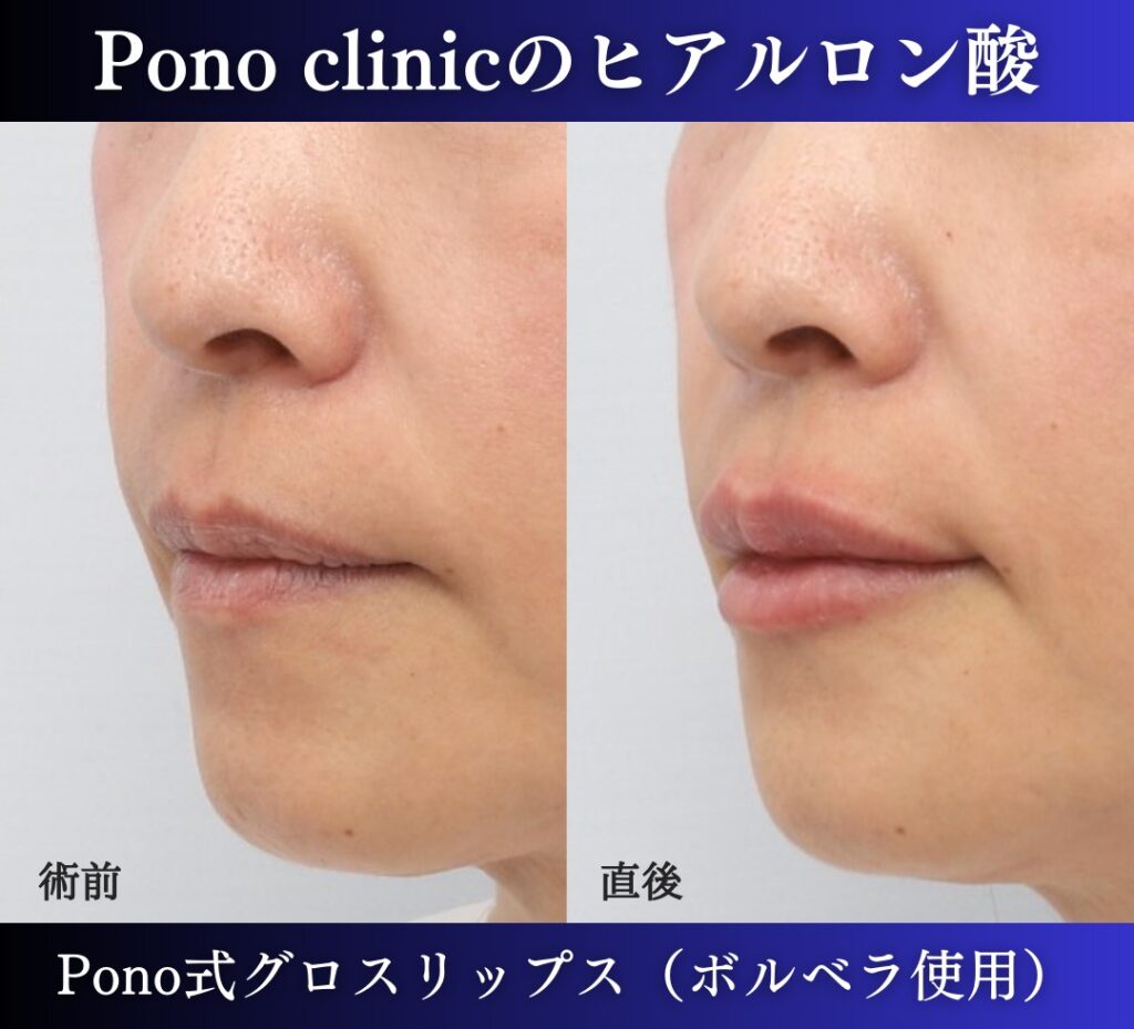 唇ヒアルロン酸注入、50代の症例 (1)