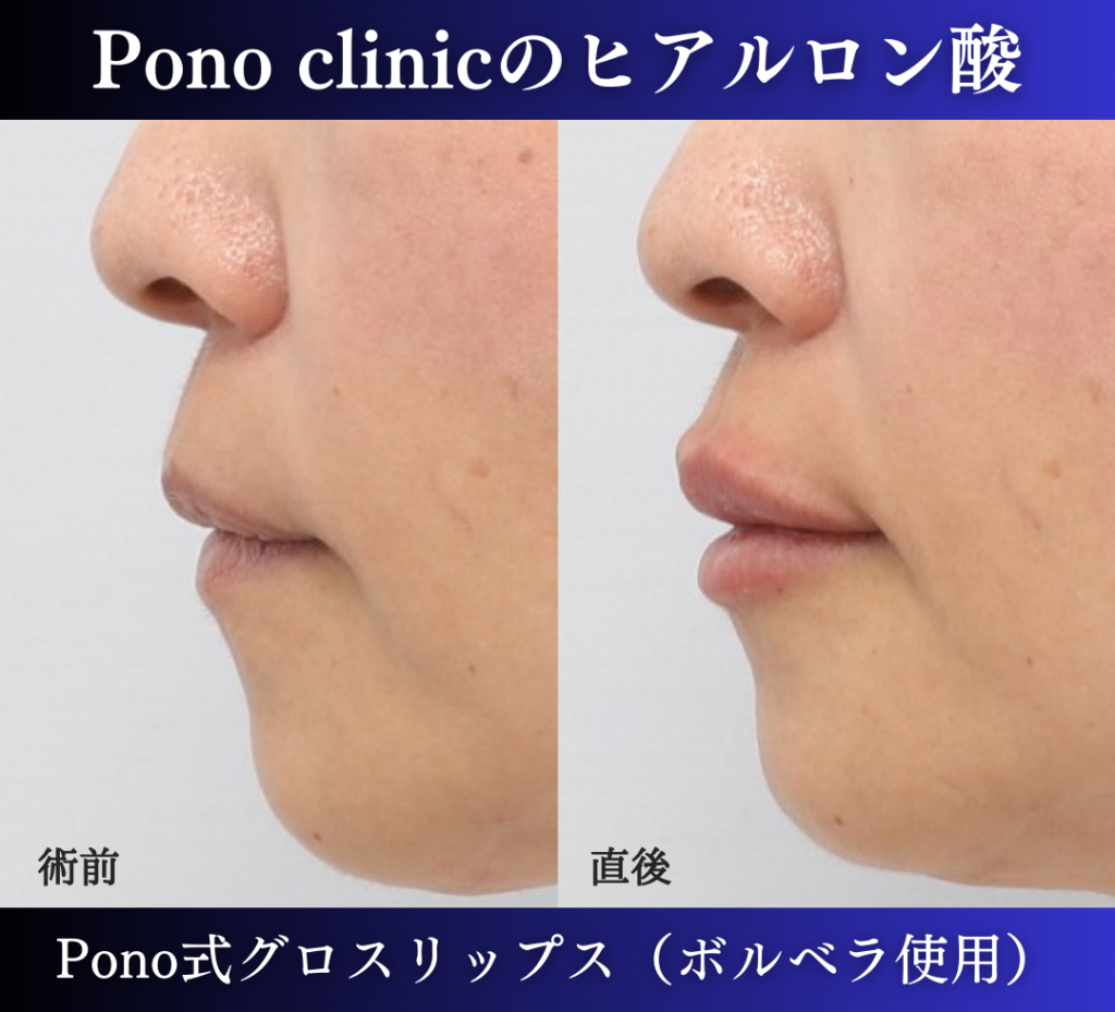 唇ヒアルロン酸注入、50代の症例 (2)