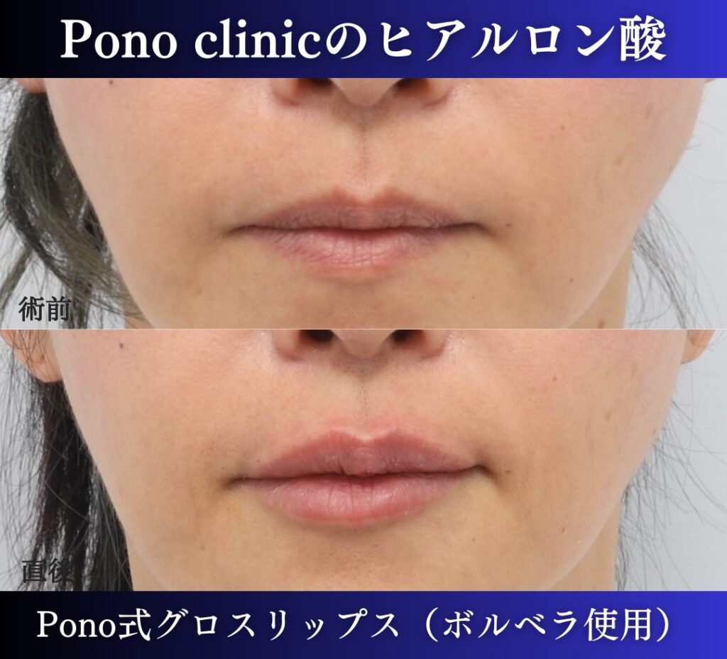 唇ヒアルロン酸注入、50代の症例 (3)