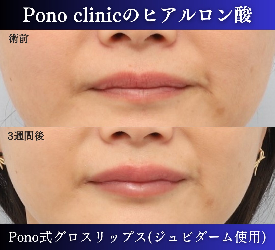 唇ヒアルロン酸注入の3週間後の症例