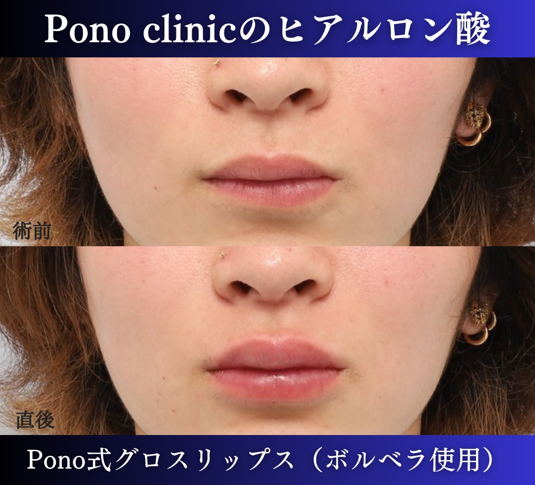 唇ヒアルロン酸注入の症例、直後 (11)