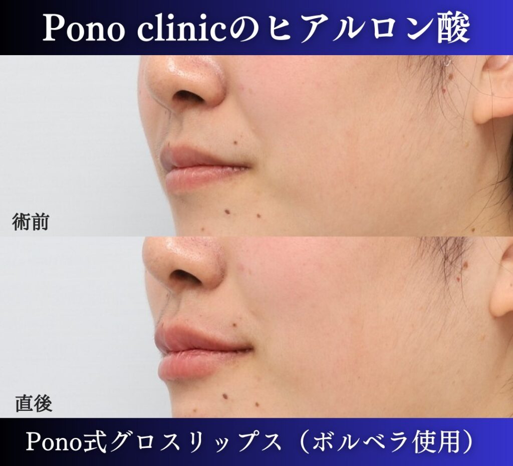 唇ヒアルロン酸注入の症例、直後 (12)