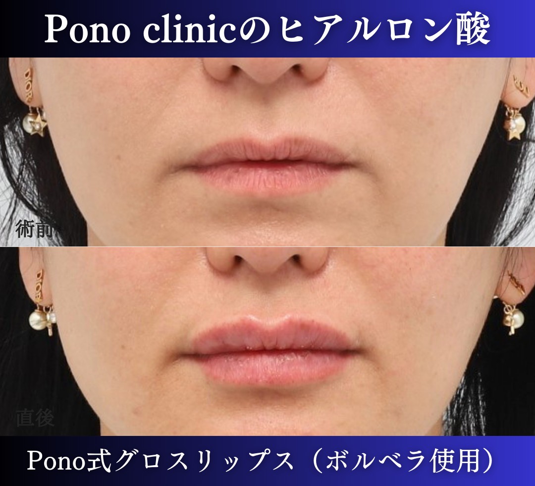 唇ヒアルロン酸注入の症例、直後 (4)