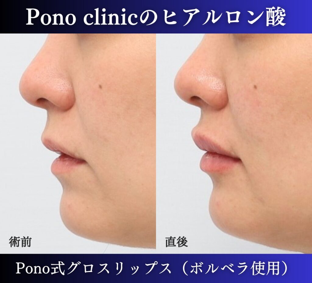 唇ヒアルロン酸注入の症例、直後 (5)