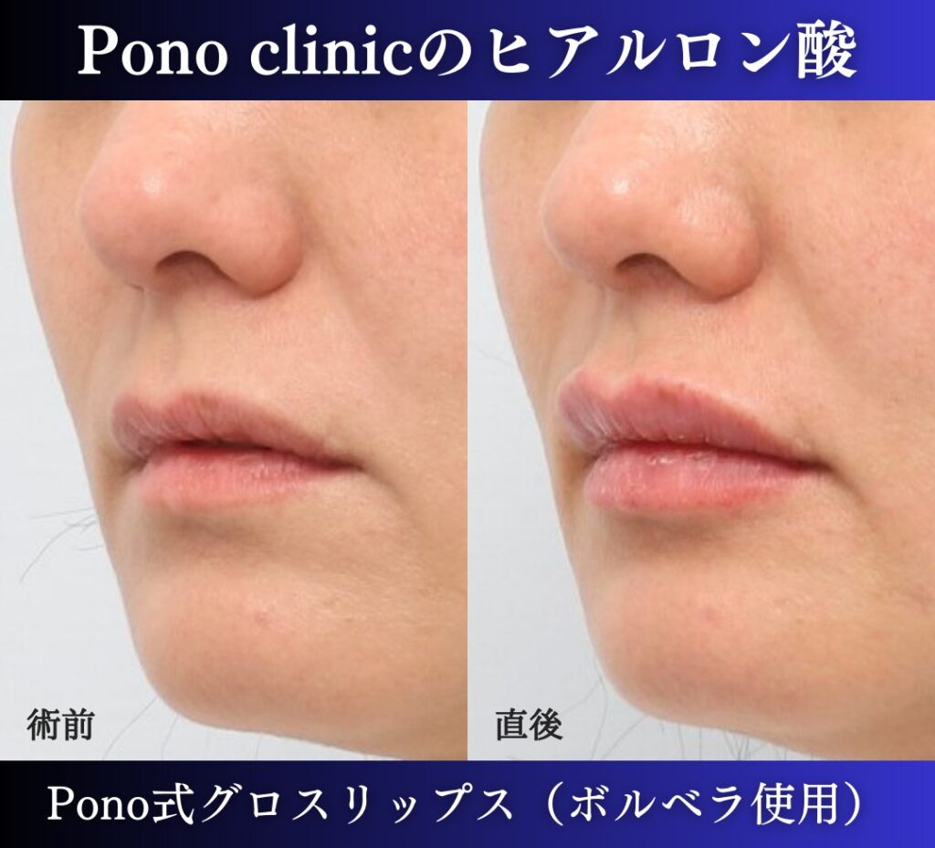 唇ヒアルロン酸注入の症例、直後 (6)