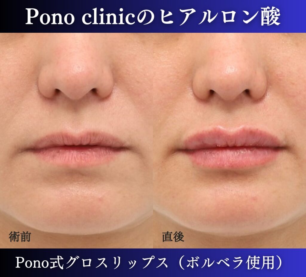 唇ヒアルロン酸注入の症例、直後 (7)