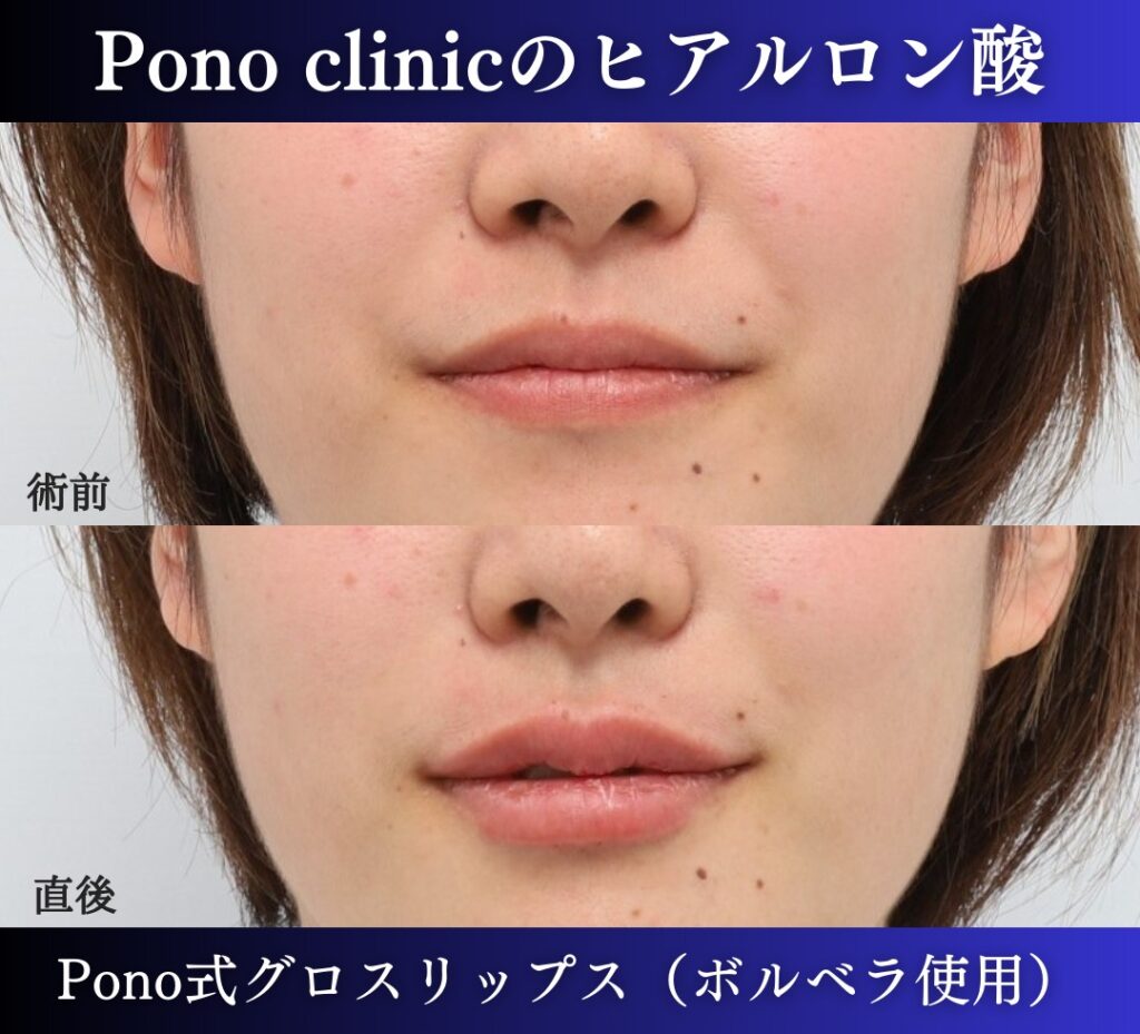 唇ヒアルロン酸注入の症例、直後 (8)