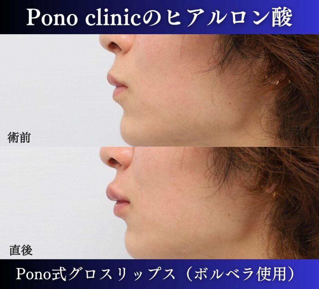 唇ヒアルロン酸注入の症例、直後 (9)