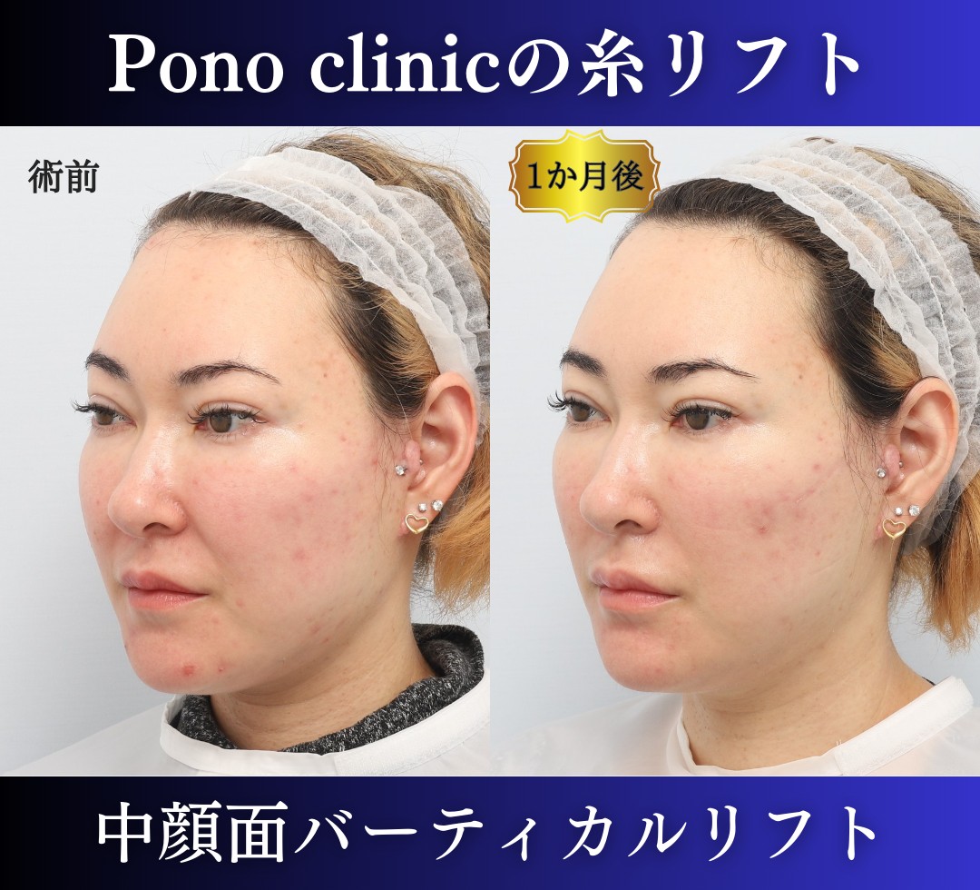 糸リフトの症例、右