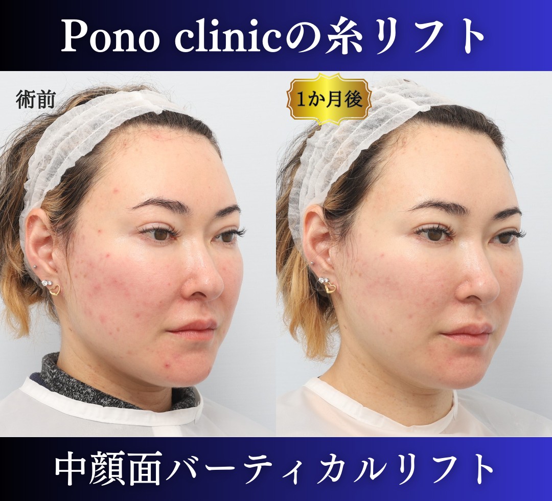 糸リフトの症例、左