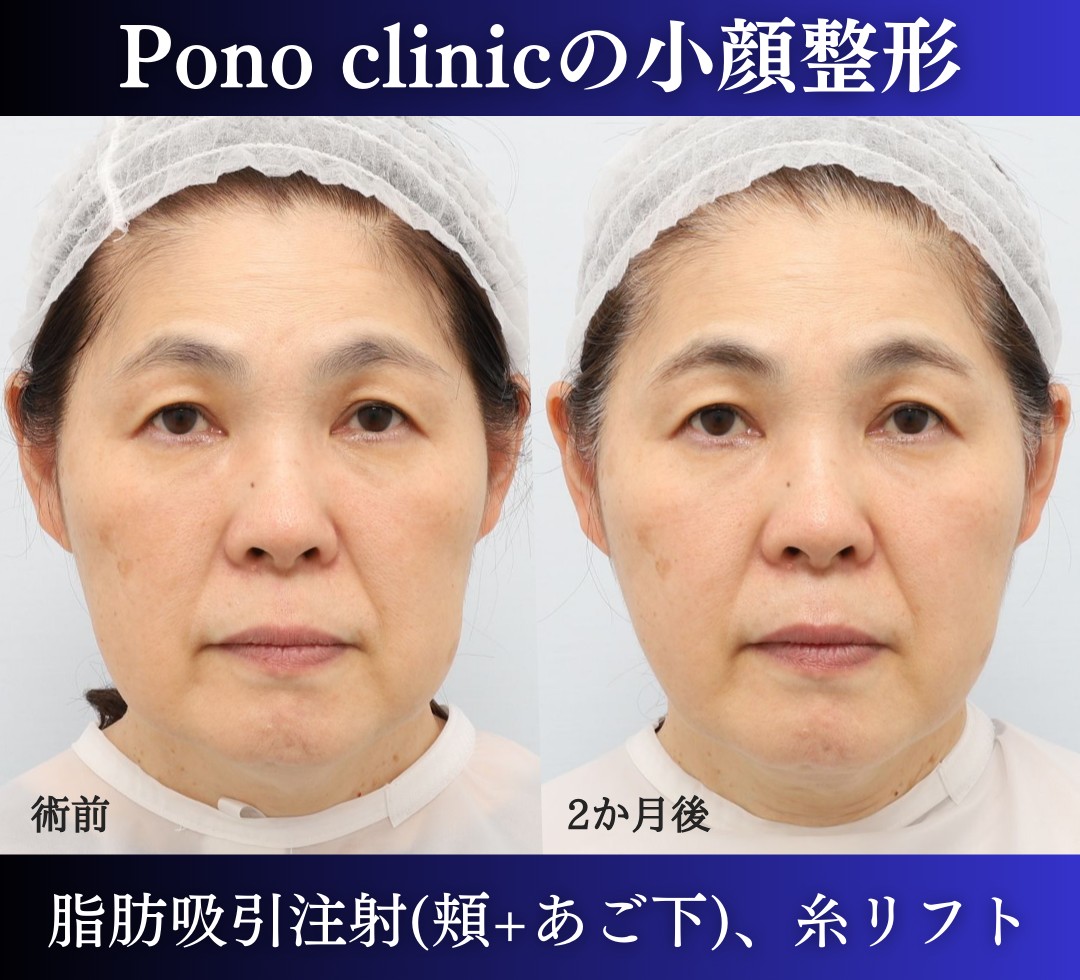 脂肪吸引、糸リフトの症例2か月後、線なし