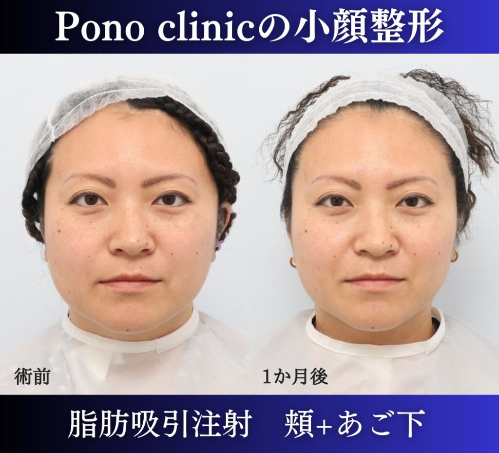 脂肪吸引注射頬+あご下の症例、1か月後正面