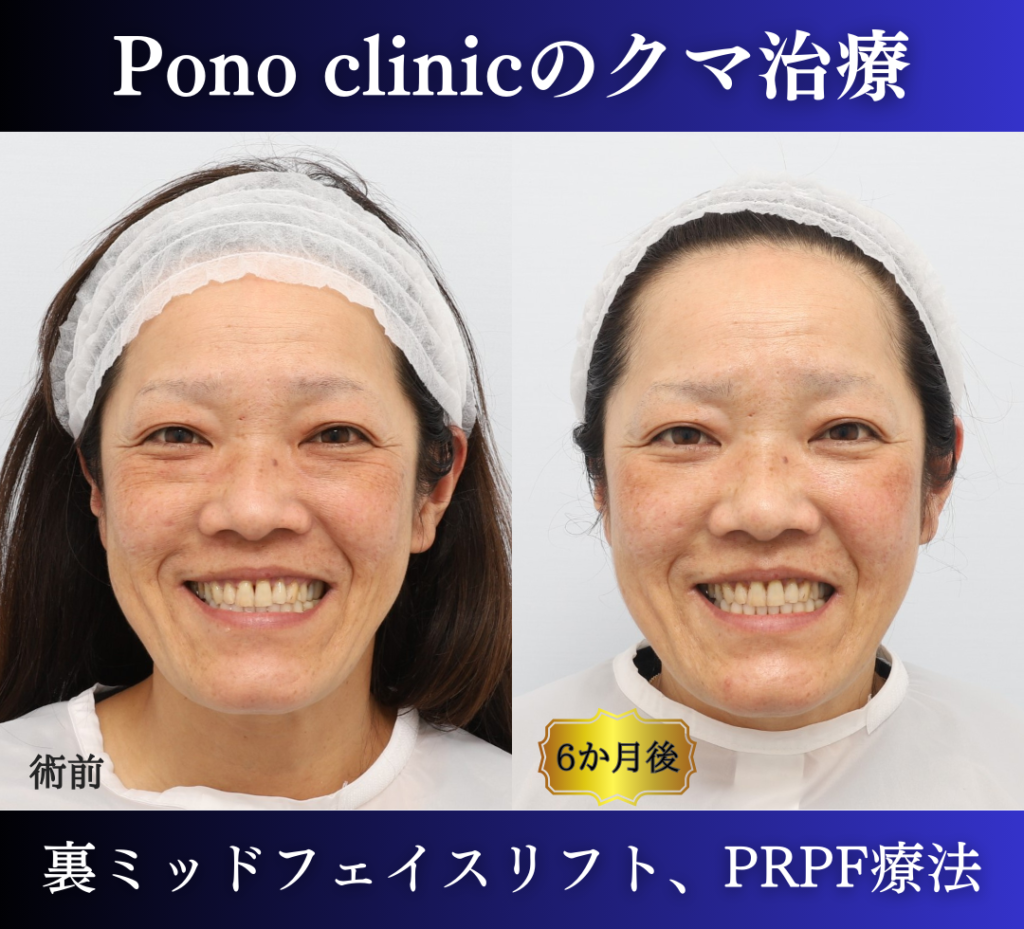 裏ハムラ、ミッドフェイスリフト、頬のPRPF療法の症例 (4)
