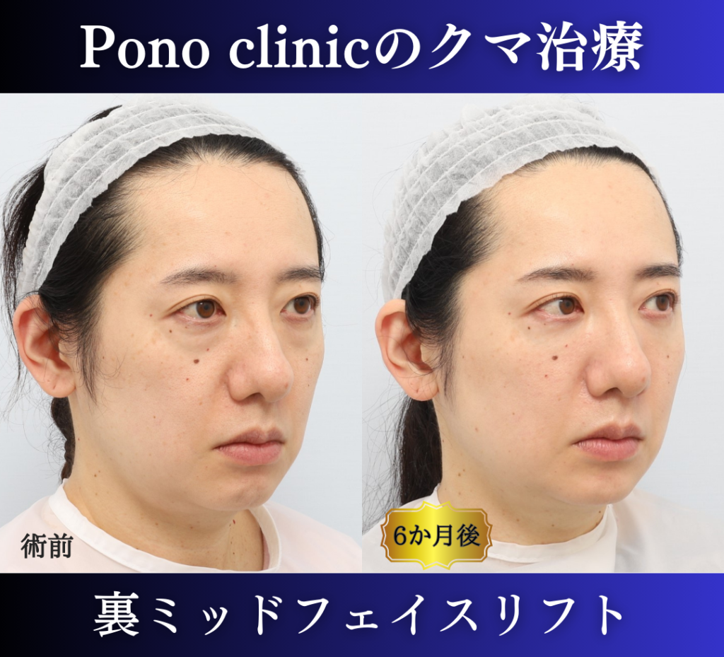 裏ハムラ、ミッドフェイスリフトの症例、40代 (1)