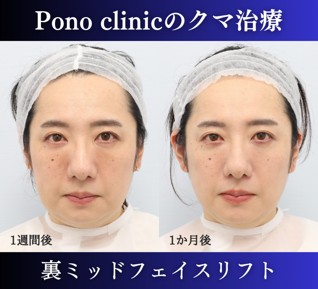 裏ハムラ、ミッドフェイスリフトの症例、40代 (3)