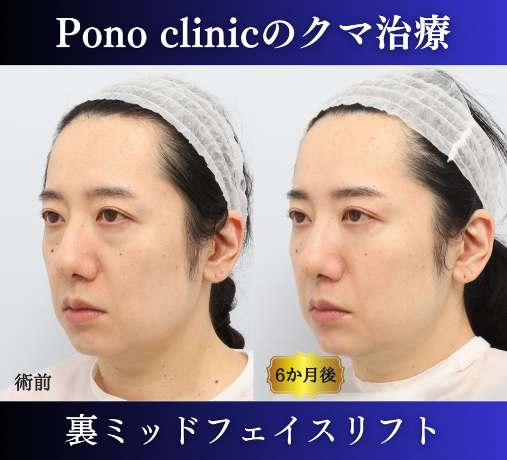 裏ハムラ、ミッドフェイスリフトの症例、40代 (4)