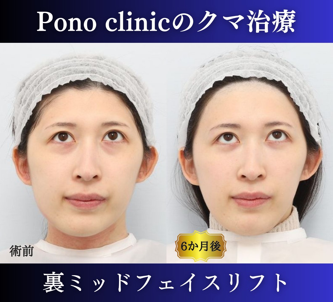 クマ取り東京、裏ハムラ、ミッドフェイスリフトの症例、半年後上向き