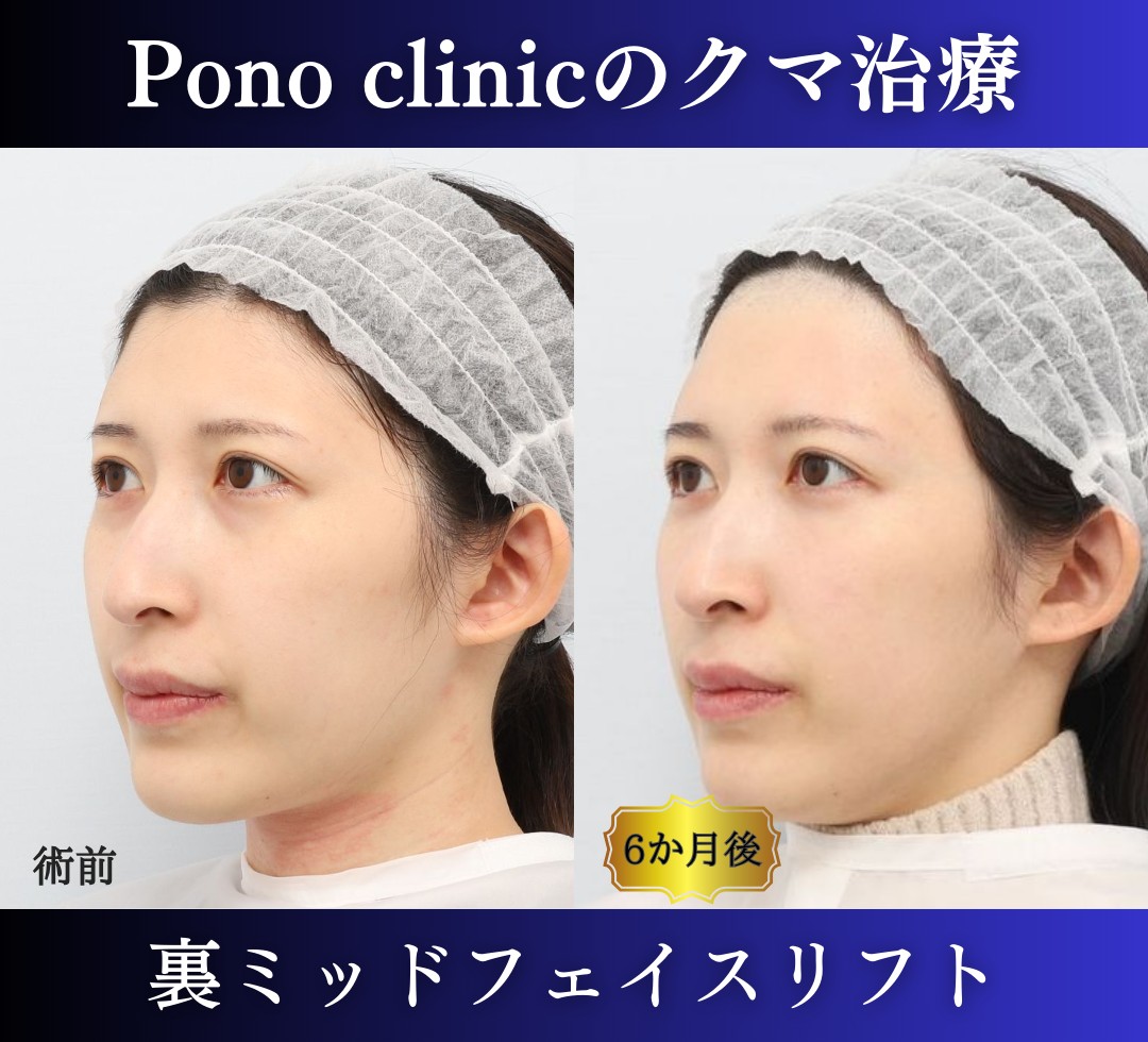 クマ取り東京、裏ハムラ、ミッドフェイスリフトの症例、半年後斜め