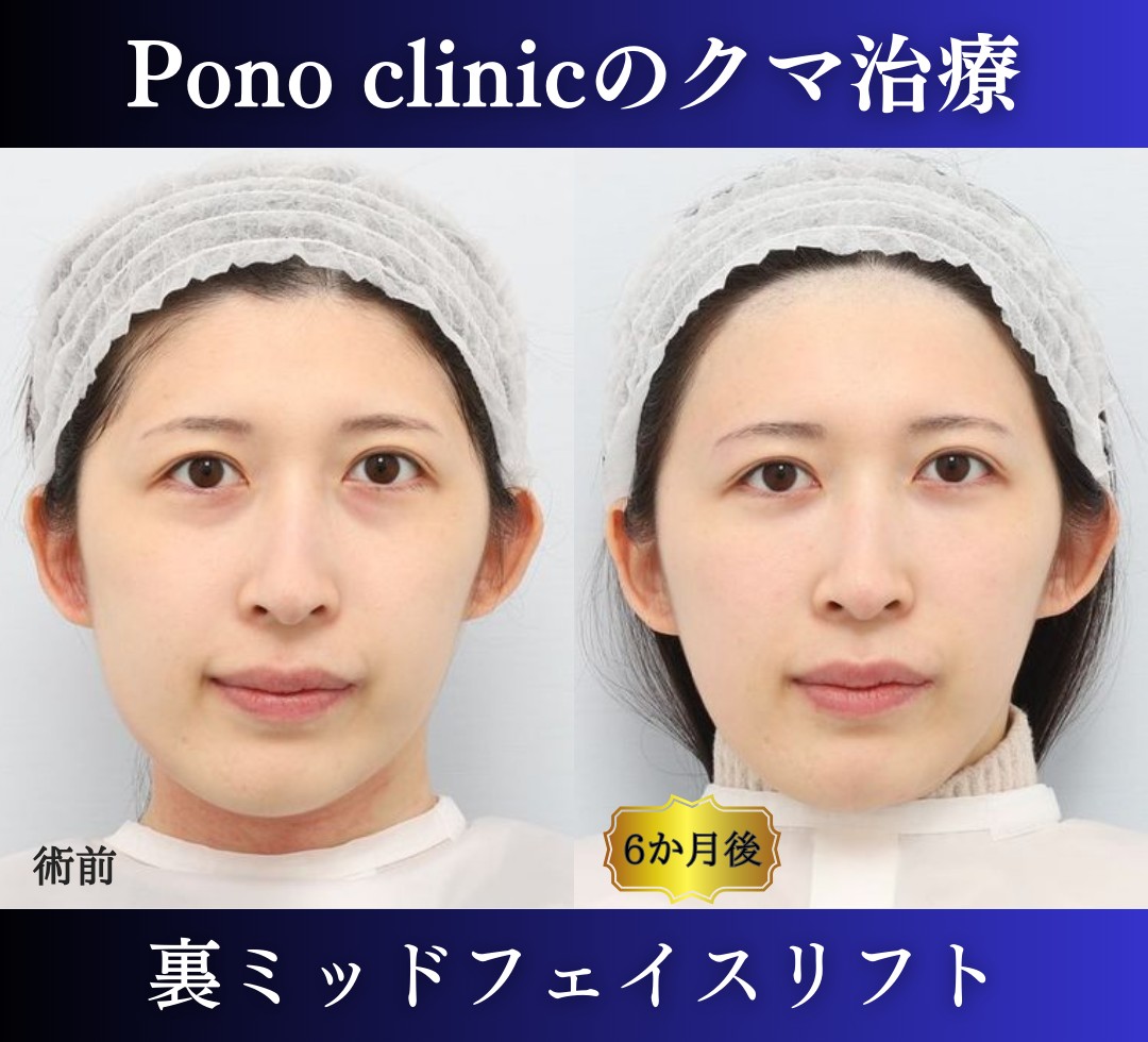 クマ取り東京、裏ハムラ、ミッドフェイスリフトの症例、半年後正面