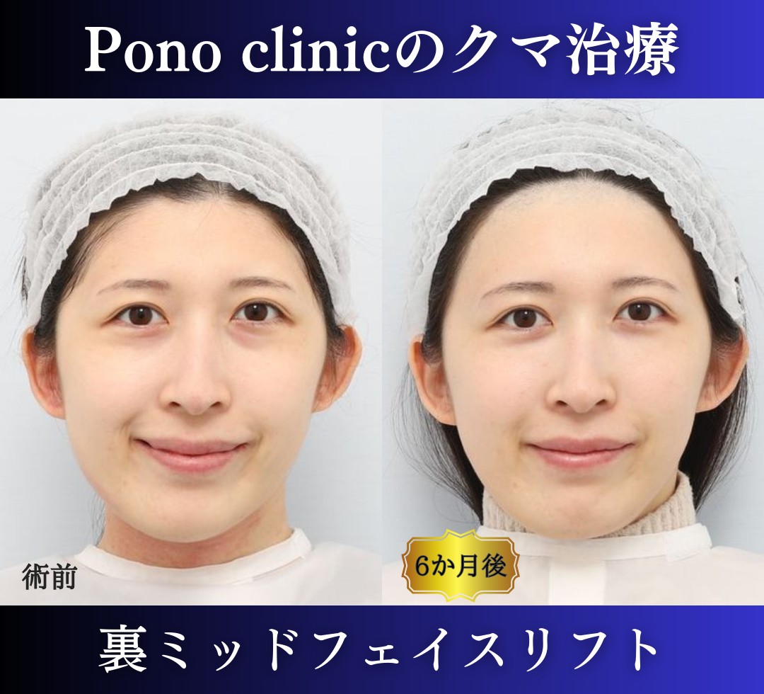 クマ取り東京、裏ハムラ、ミッドフェイスリフトの症例、半年後笑顔