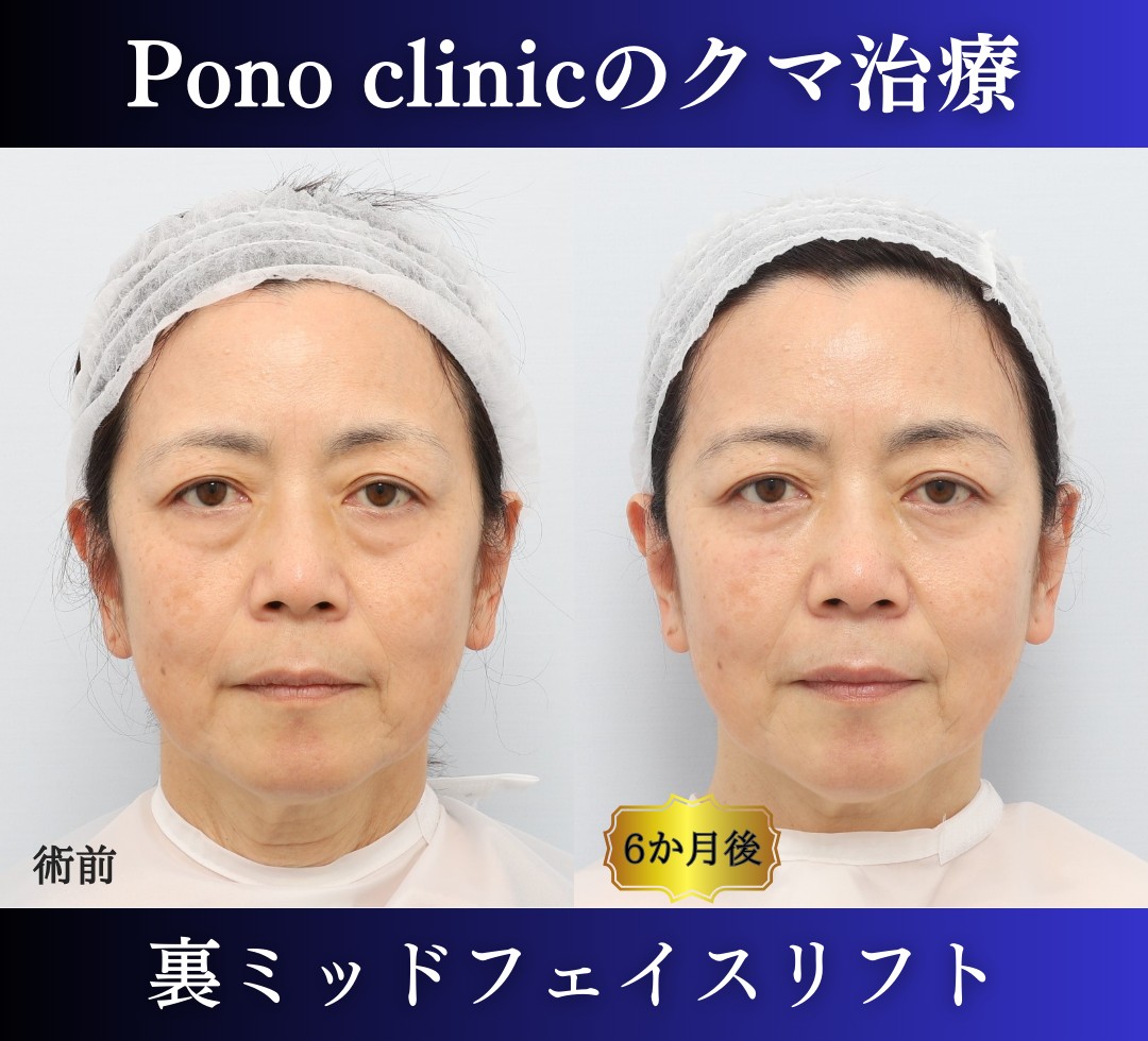 クマ取り東京、裏ハムラ、ミッドフェイスリフト症例、正面