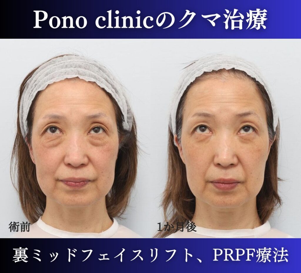 裏ハムラ・ミッドフェイスリフト、PRPF療法目の上の症例、上目線