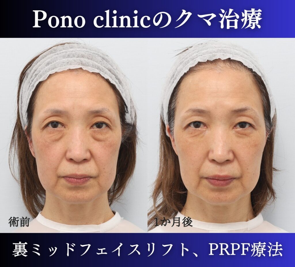 裏ハムラ・ミッドフェイスリフト、PRPF療法目の上の症例、前
