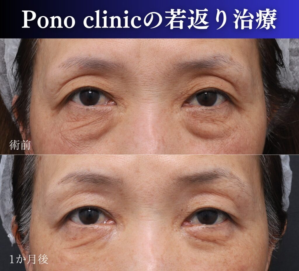 裏ハムラ・ミッドフェイスリフト、PRPF療法目の上の症例アップ