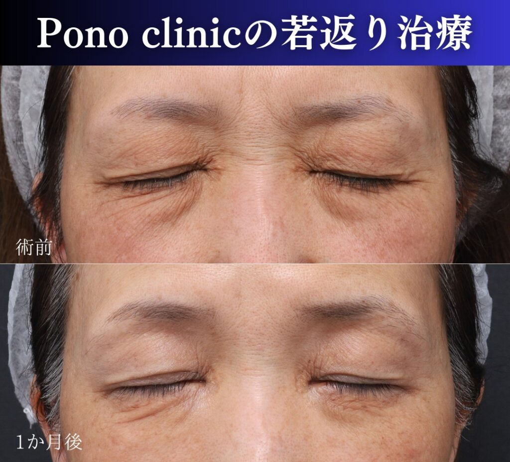 裏ハムラ・ミッドフェイスリフト、PRPF療法目の上の症例閉眼