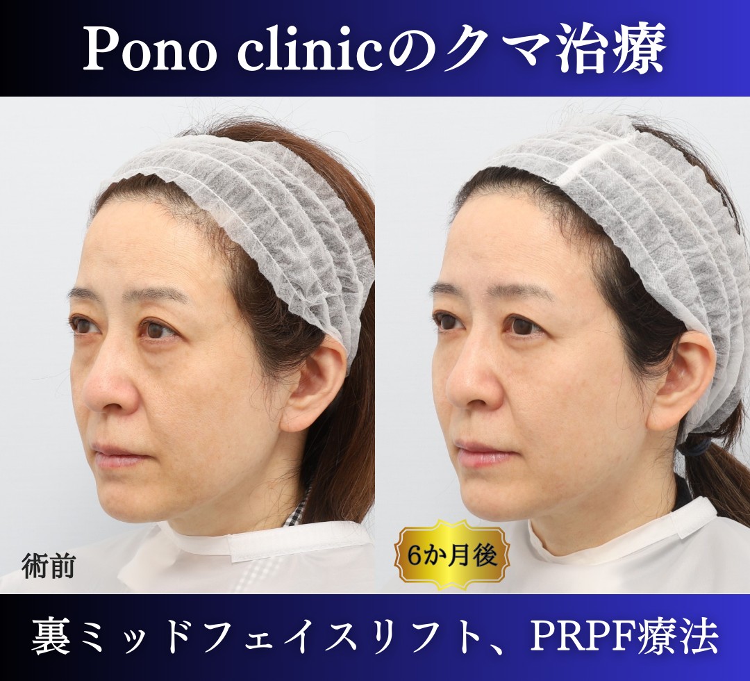 クマ取り東京、裏ハムラ・ミッドフェイスリフト、PRPF療法目の下の症例、右