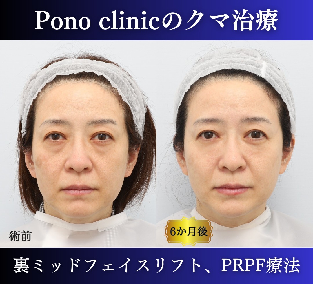 クマ取り東京、裏ハムラ・ミッドフェイスリフト、PRPF療法目の下の症例、正面