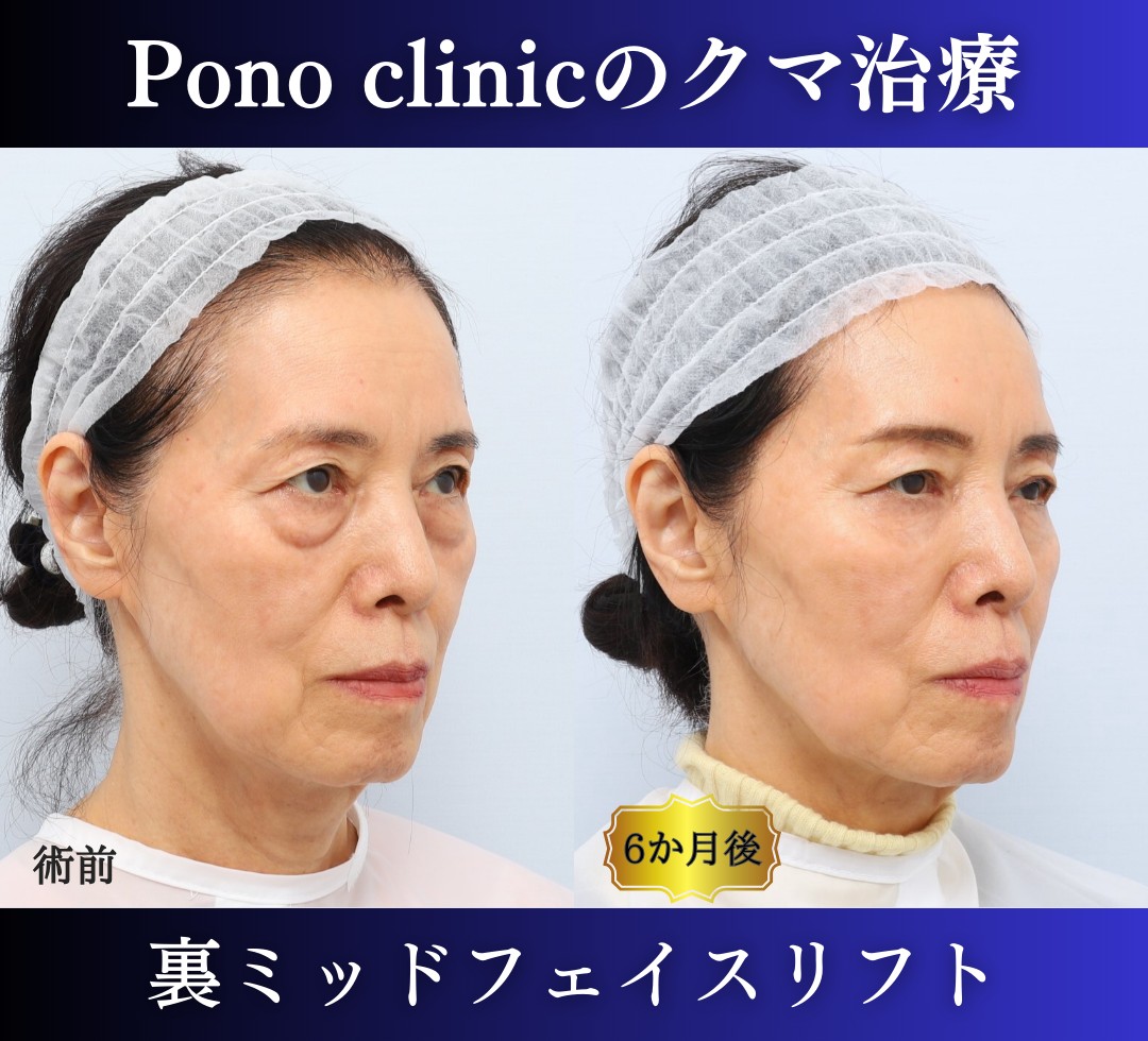 クマ取り東京、裏ミッドフェイスリフト70代の症例、半年後左