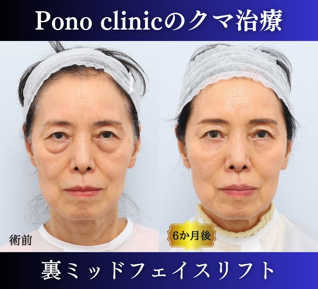 クマ取り東京、裏ミッドフェイスリフト70代の症例、半年後正面