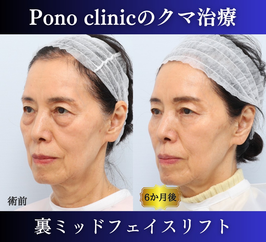 クマ取り東京、裏ミッドフェイスリフト70代の症例、半年後正面右